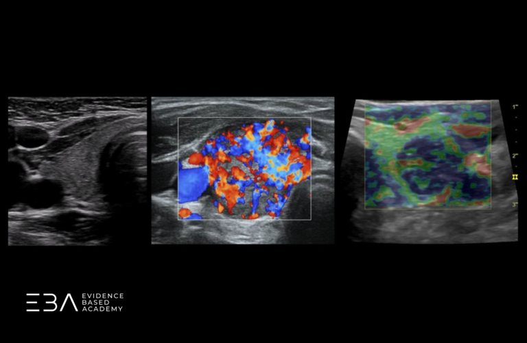 Obraz tarczycy w B-Mode, Color Doppler i elastografii.