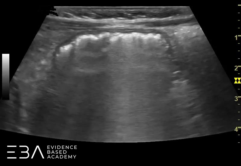 Żołądek w okolicy dna. Pośrednie wypełnienie żołądka płynną treścią i gazami. Widoczne pofałdowania błony śluzowej.