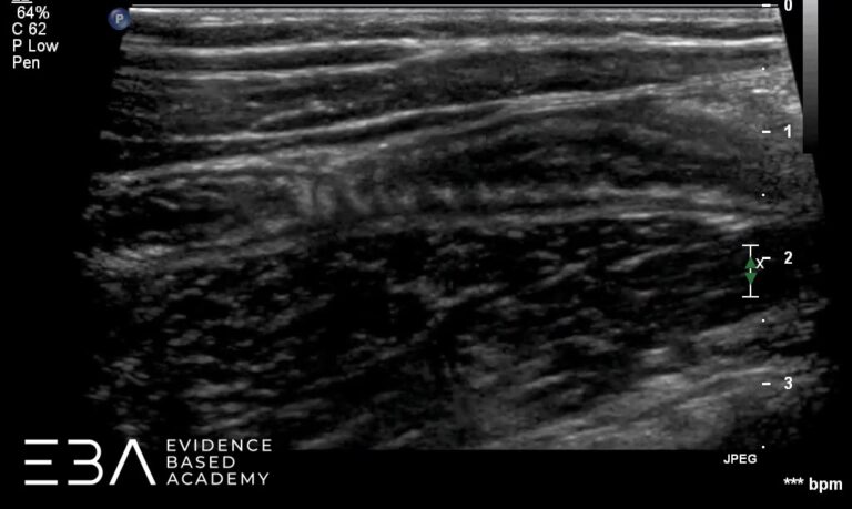 Badanie w czasie rzeczywistym. Wyrostek robaczkowy w przekroju poprzecznym. Ocena unaczynienia w opcji Color Doppler.