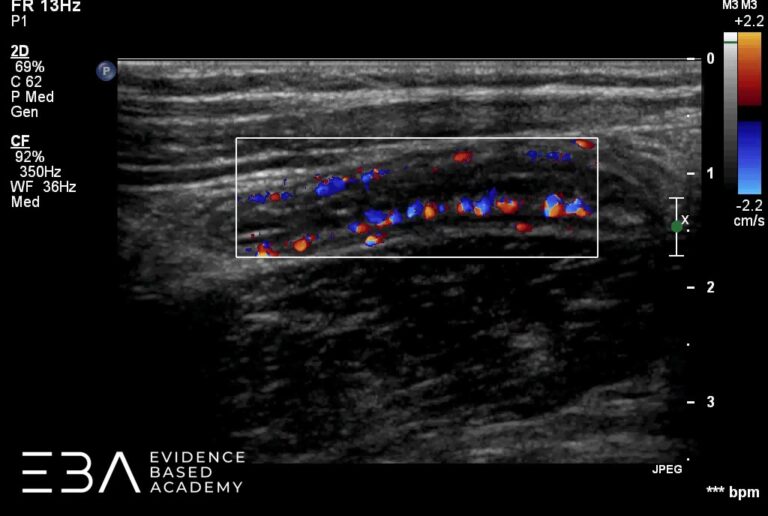 Badanie w czasie rzeczywistym. Wyrostek robaczkowy w przekroju podłużnym. Ocena unaczynienia w opcji Color Doppler.