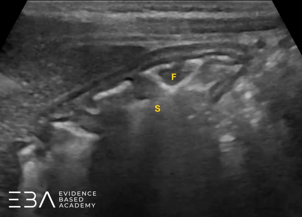 Żołądek na poziomie dna. Przekrój poprzeczny. Widoczna budowa warstwowa ściany żołądka. S - światło żołądka; F - fałd błony śluzowej