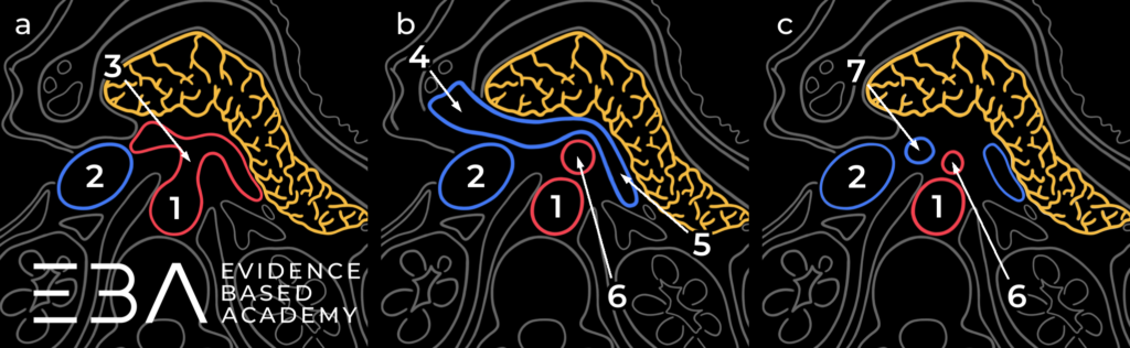 Naczynia w okolicy trzustki na trzech poziomach: a) odejście pnia trzewnego, b) spływ żyły wrotnej, c) poniżej spływu. 1 - aorta; 2 - żyła główna dolna; 3 - pień trzewny z odgałęzieniami; 4 - pień żyły wrotnej; 5 - żyła śledzionowa; 6 - tętnica krezkowa górna; 7 - żyła krezkowa górna.