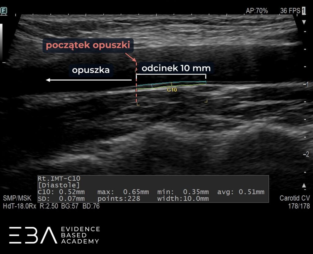 Początek opuszki i odcinek 10 mm w stronę serca, na którym mierzymy cIMT.