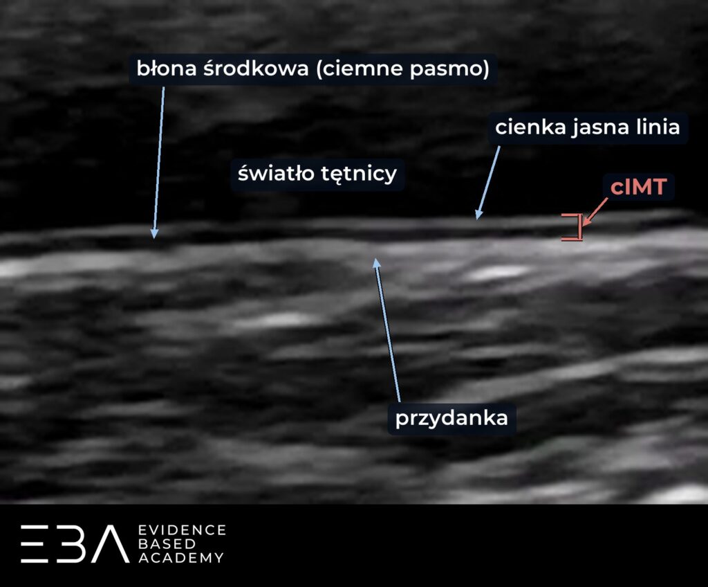 Ściana dalsza tętnicy szyjnej wspólnej: cienka jasna linia, błona środkowa (ciemne pasmo) i przydanka. cIMT mierzymy od górnej krawędzi cienkiej linii do górnej krawędzi przydanki.